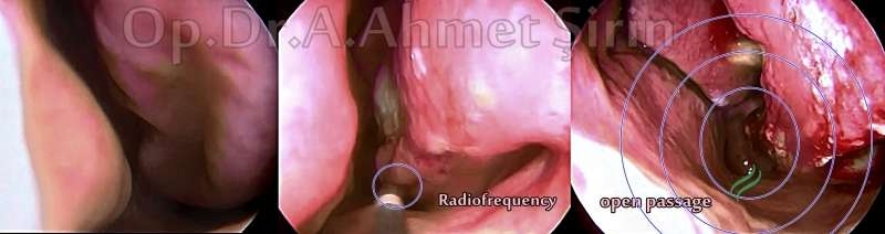 radiofrequency