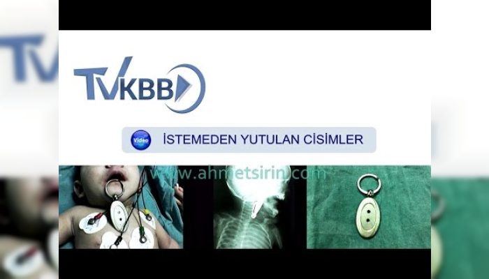 yutulan cisim,istemeden yutulan cisim,bogaza kaçan ciaim,boğaza para kaçması,bogaza oyuncak kaçması