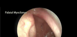 palatal-myoklonus-objektif-tinnitus-nedeni