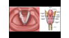 Larynx (Anatomical Structure),Gırtlak kanseri,ses kısıklığı,tümör,ses hastalıkları,boğaz ağrısı,sigara ve kanser,alkol ve kanser
