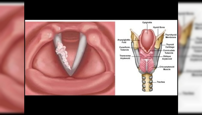 Larynx (Anatomical Structure),Gırtlak kanseri,ses kısıklığı,tümör,ses hastalıkları,boğaz ağrısı,sigara ve kanser,alkol ve kanser