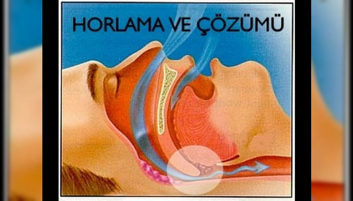 uyku apnesi,uykuda tıkanma,apne,uykuda nefes durması,uykuda nefesin kesilmesi,uyku bozuklukları,horlama tedavisi,horlamanın çözümü,horlamadan nasıl kurtulunur,horlama cerrahisi,horlama ameliyatı,horlama,Snoring (Symptom),tıkanma