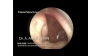 palatal-myoclonus-objektif-tinnitus-nedeni