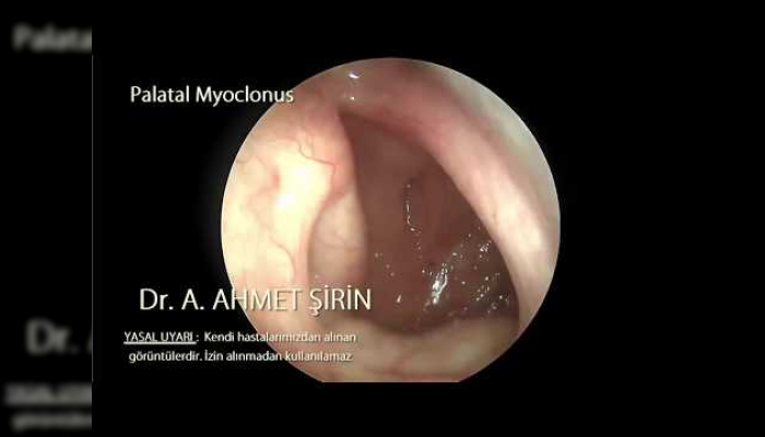 palatal-myoclonus-objektif-tinnitus-nedeni