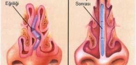 septum-deviasyonu-burun-kikirdak-egriligi