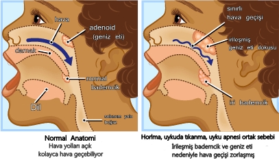 cocukta-horlama-ve-uykuda-tikanma-nedenleri