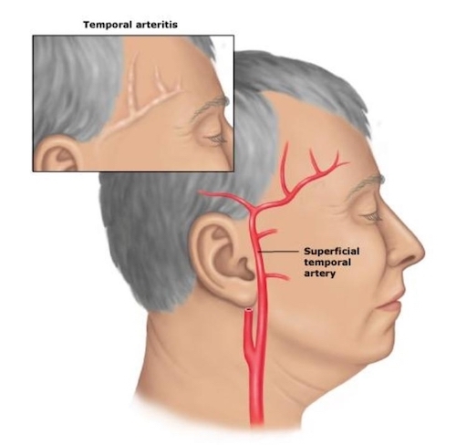 temproral-arteritis