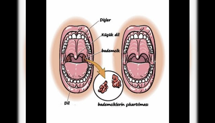 Bademcik,Bademcik iltihabı,Bademcik ameliyatı,Bademcik ameliyatı gereklimi,Boğaz ağrısı,Geniz eti,bademcik şişmesi,Tonsil (Anatomical Structure),Health (Industry),bademcik ameliyatı nasıl yapılır,çocukta bademcik,bademcik nasıl alınır,bad