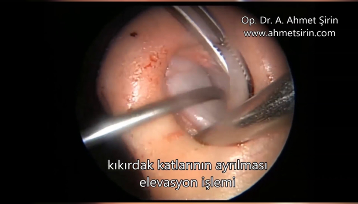 Nasal Septum Deviation (Disease Or Medical Condition),Septoplasty (Medical Treatment),septum deviasyonu ameliyatı,deviasyon ameliyatı,burun kıkırdak amaliyatı,burun,septum,deviasyon,konka,endoscopic septoplasty,inferior konka,konka hipertrofi,nasal s