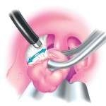 bademcikte-apselesme