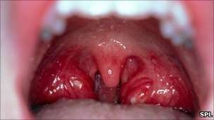 geniz-eti-tedavisi-nasil-yapilir