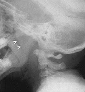 geniz-etinin-neden-oldugu-olumsuz-etkiler-nelerdir