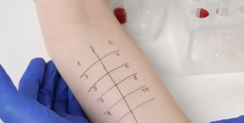 alerji-testi-prick-test