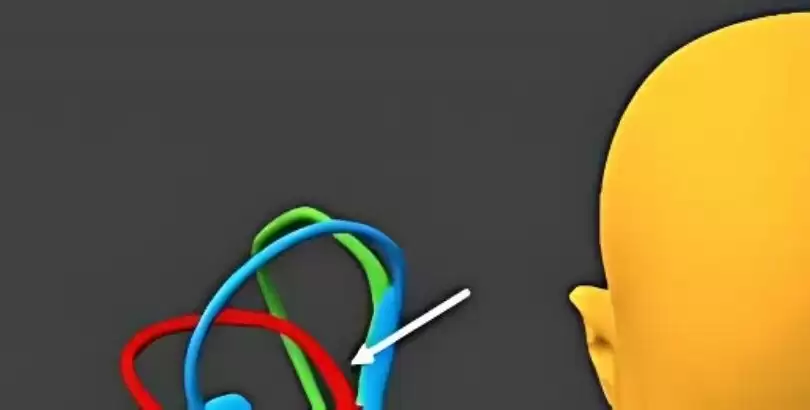 bppv-benign-paroxysmal-positional-vertigo-da-horizontal-semicircular-kanalin-apogeotropic-varianti