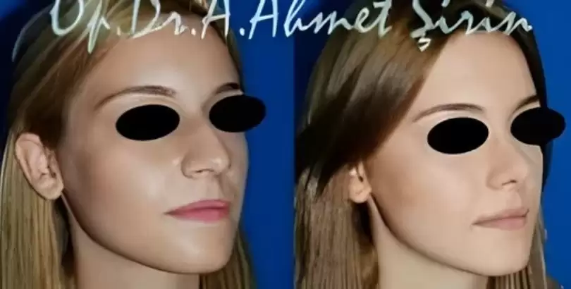 burun-estetigi-foto-galeri