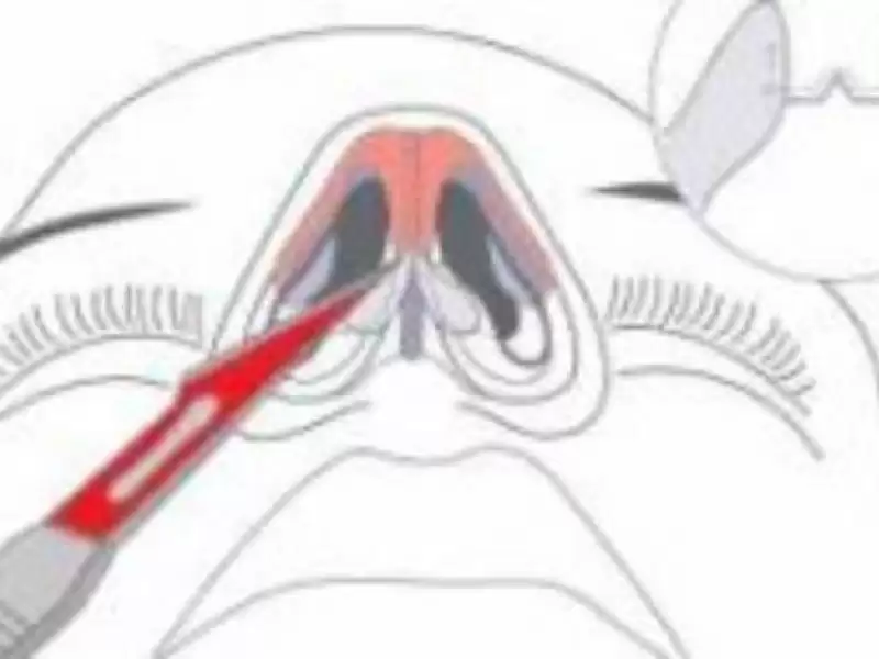 burun-estetiginde-ameliyatin-asamalari