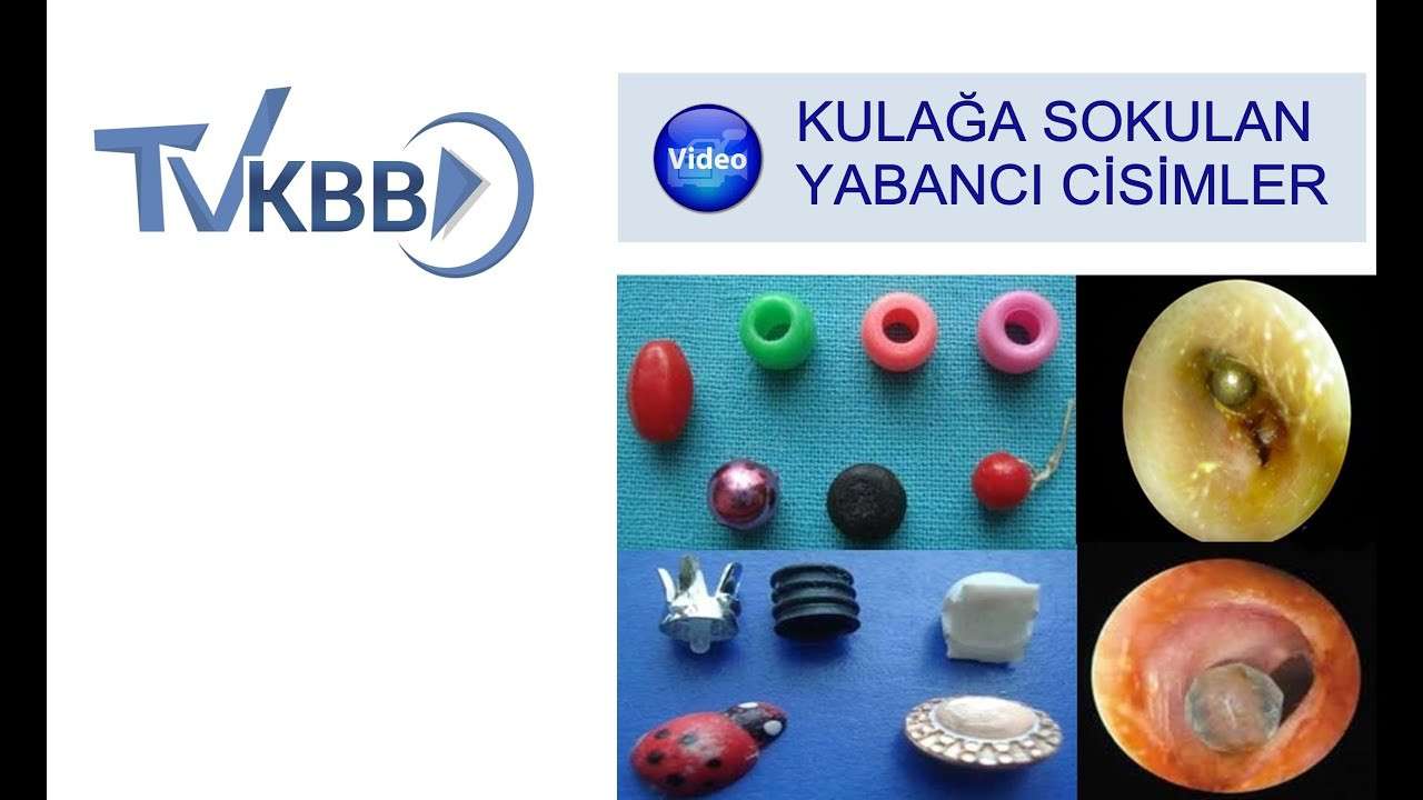kulak,kulakta yabancı cisim,kulakta boncuk,kulağa boncuk kaçması