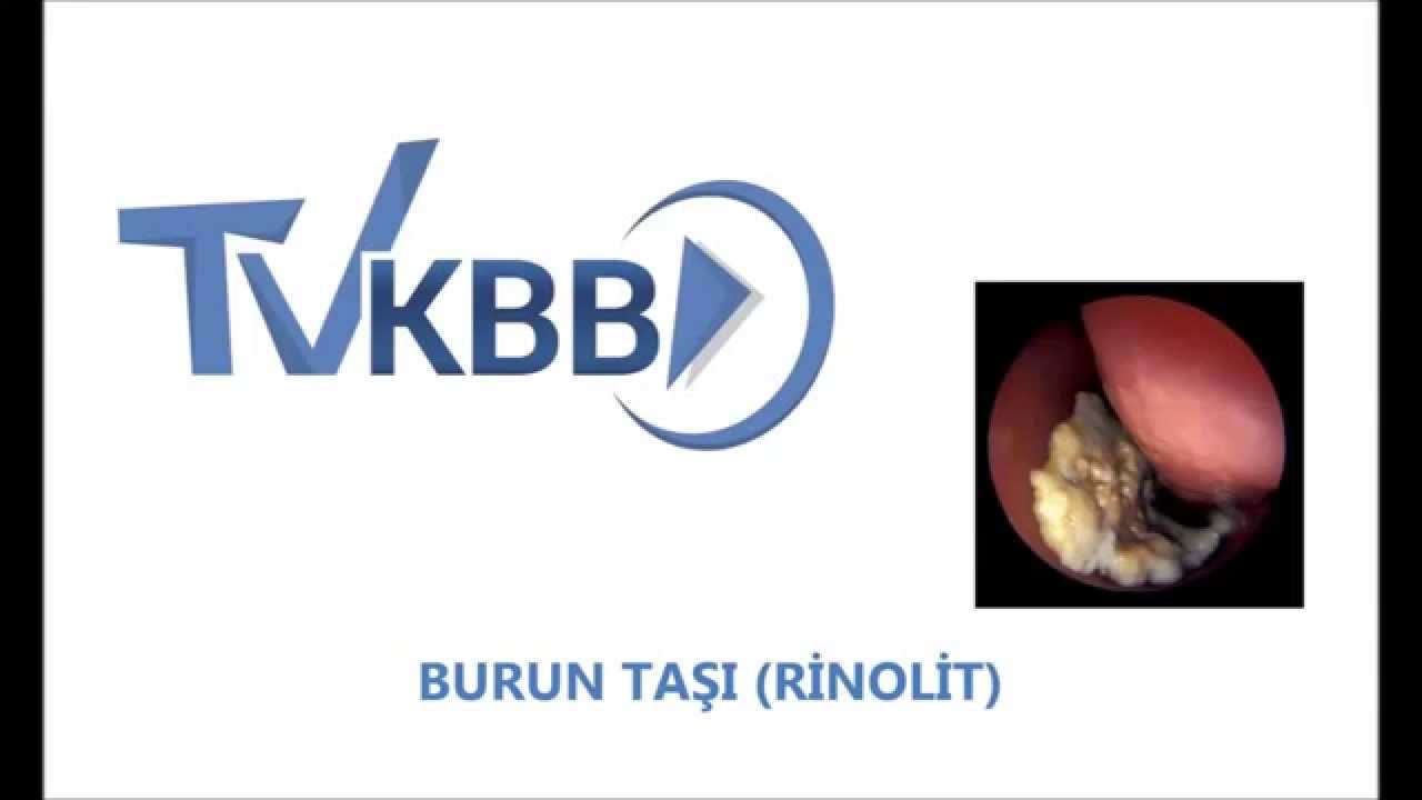 burun taşı,rinolit,burunda yabancı cisim,burun tıkanıklığı,çocukta burun tıkanıklığı yapan sebepler,rhinolit