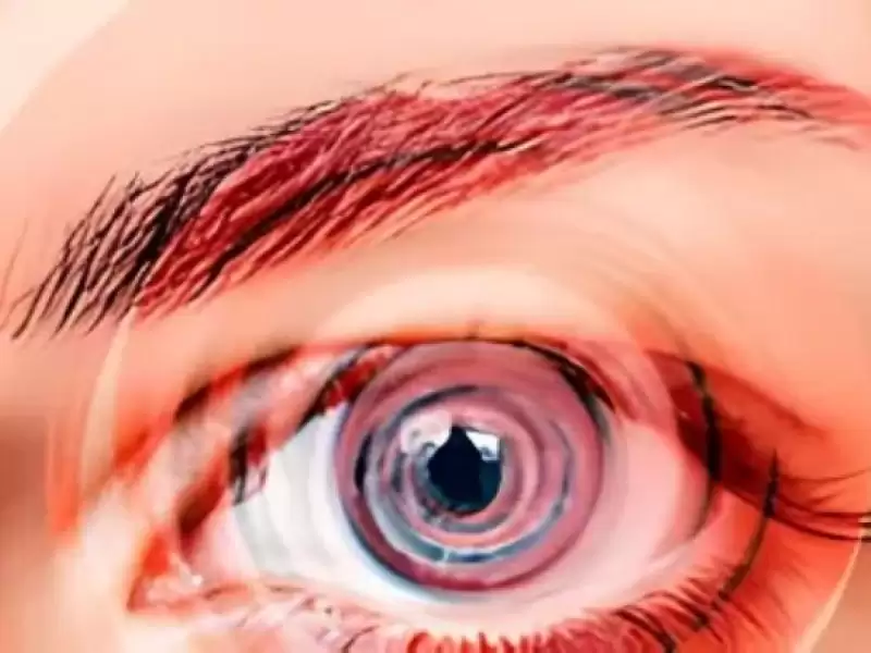 endolenfatik-hidrops