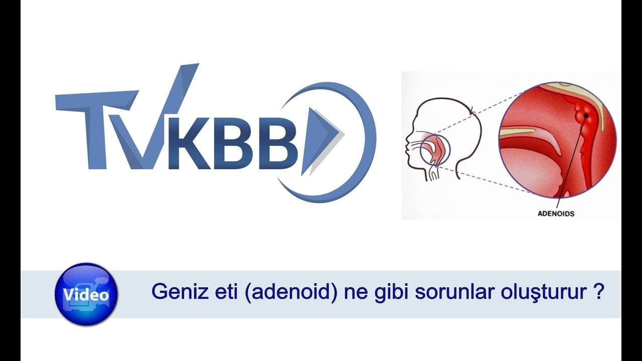 geniz eti,adenoid,geniz eti sorunları,geniz eti ne yapar,burun tıkanması,adenoid vejetasyon