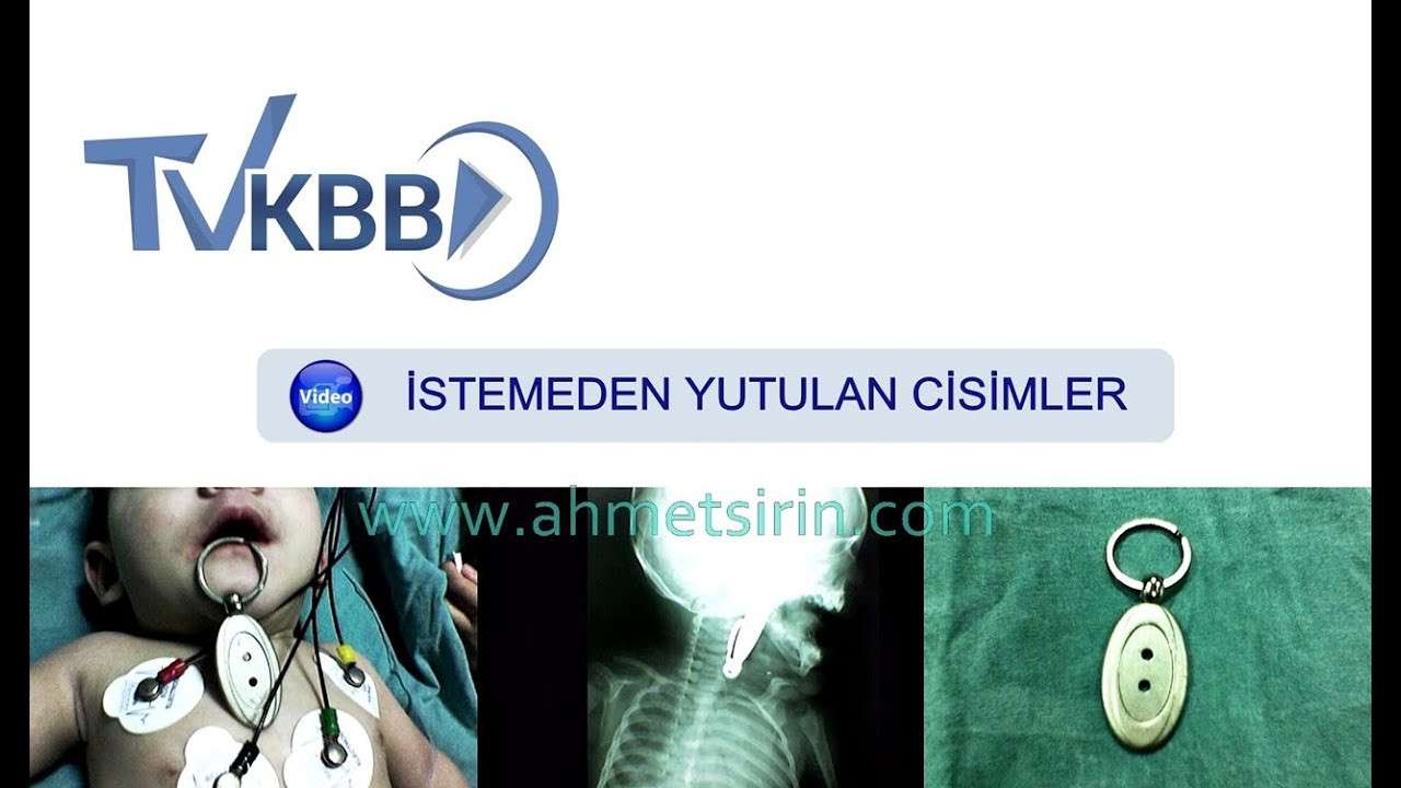 yutulan cisim,istemeden yutulan cisim,bogaza kaçan ciaim,boğaza para kaçması,bogaza oyuncak kaçması