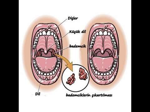 Bademcik,Bademcik iltihabı,Bademcik ameliyatı,Bademcik ameliyatı gereklimi,Boğaz ağrısı,Geniz eti,bademcik şişmesi,Tonsil (Anatomical Structure),Health (Industry),bademcik ameliyatı nasıl yapılır,çocukta bademcik,bademcik nasıl alınır,bad