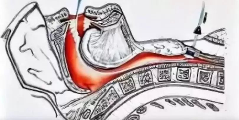 girtlak-kanseri-sonrasi-ses-protezi-nasil-uygulanir