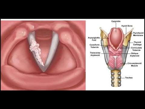 Larynx (Anatomical Structure),Gırtlak kanseri,ses kısıklığı,tümör,ses hastalıkları,boğaz ağrısı,sigara ve kanser,alkol ve kanser