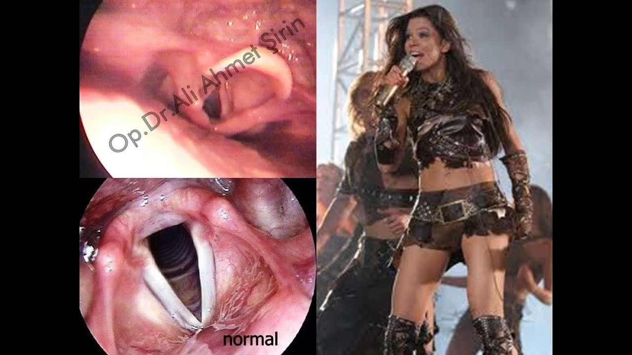 Ruslana (Musical Artist),Ses kısıklığı,ses teli,ses teli hastalıkları,ses kısıklığı hastalıkları,sesin kısılması,ses teli nodülü,ses teli polibi