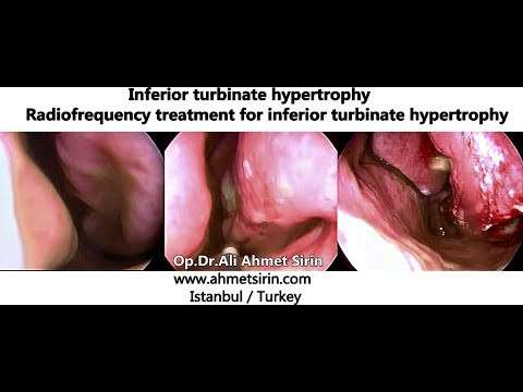 burun eti,burun eti küçültülmesi,radyofrekans ile burun eti küçültülmesi,burun tıkanıklığı,burun cerrahisi,burun eti şişmesi,burundan nefes alamama,nasal blokaj,Radiofrequency treatment for inferior turbinate hypertrophy,burun,burundan nefe