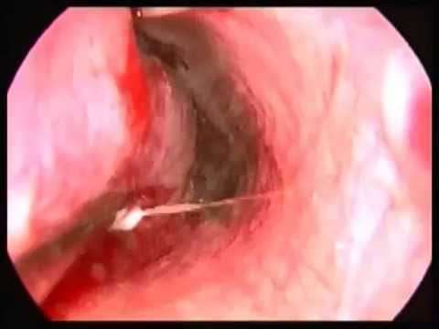 burun eti,nefes alamama,konka hipertrofisi,burun tıkanıklığı,radyofrekans,burun ameliyatı,ağrısız burun ameliyatı,Nose (Human Sense Organ),inferior turbinate hypertrophy,inferior turbinate hypertrophy treatment,Nasal Cavity (Anatomical Structure