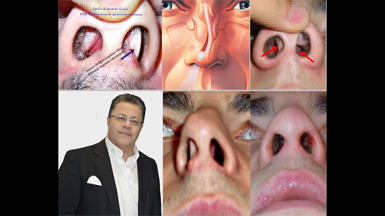 Burun tıkanıklığı,deviasyon,burun etleri,konka hipertrofisi,septum deviasyonu,nefes alamama,burun ameliyatı,deviasyon ameliyatı,burun,Burun kemiği ameliyatı,burun tıkanıklığı,Op.Dr.Ahmet şirin,ahmet şirin,ali ahmet şirin,Dr ahmet şirin,b
