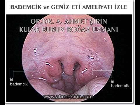 bademcik ameliyatı,genizeti ameliyatı,tonsilektomi,Adenoid (Anatomical Structure),Tonsillectomy (Medical Treatment),adenoidektomi,kronik bademcik,Tonsil (Anatomical Structure)