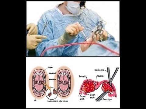 Tonsil,Tonsillectomy (Medical Treatment),Tonsillitis (Disease Or Medical Condition),Adenoid (Anatomical Structure)