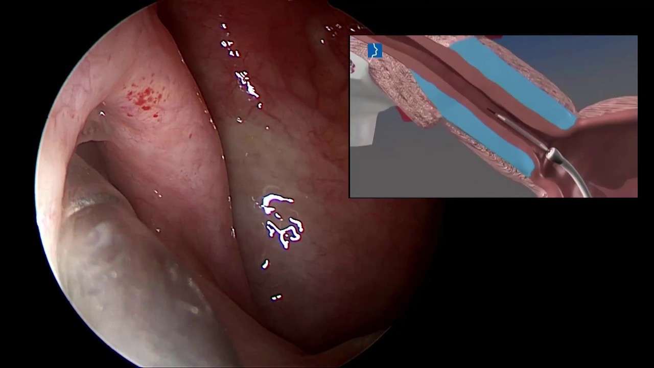 östaki balon tuboplasti,Balloon Eustachian Tube Dilation to Treat Eustachian Tube Dysfunction,Eustachian Tube Dysfunction,Eustachian Tuboplasty,Eustachian Tube,Eustachian Tube Balloon Dilation,östaki kanalı,orta kulak basıncı,orta kulak hastalığı,