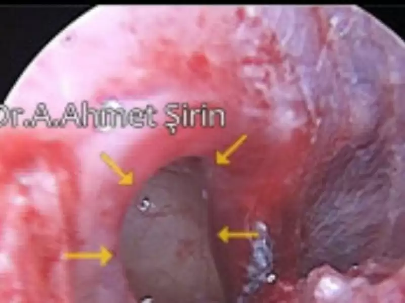 kulak-zari-delinmeleri-tinnitus-iliskisi