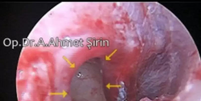 kulak-zari-delinmeleri-tinnitus-iliskisi