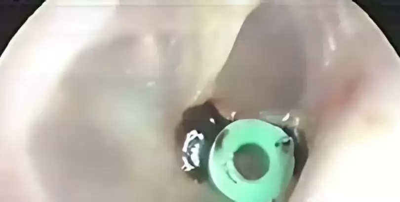 orta-kulakta-sivi-toplanmasi-ve-kulak-tupu-ameliyati