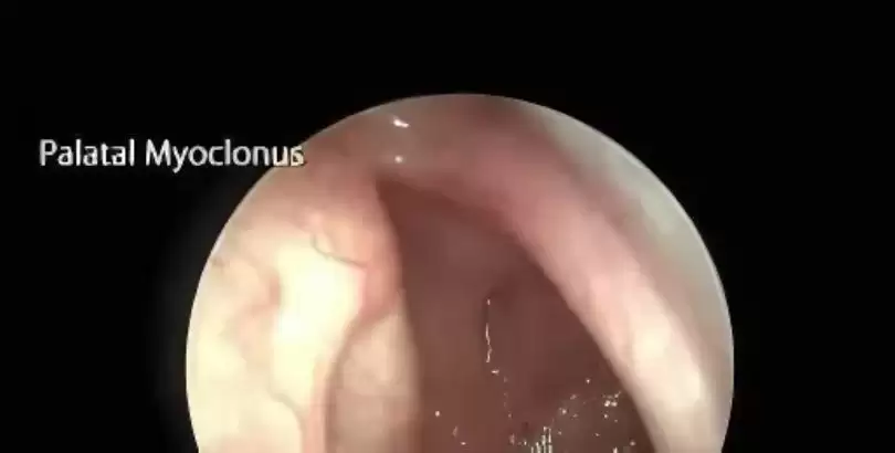 palatal-myoklonus-objektif-tinnitus-nedeni