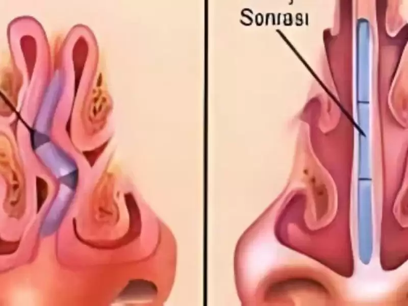 septum-deviasyonu-burun-kikirdak-egriligi