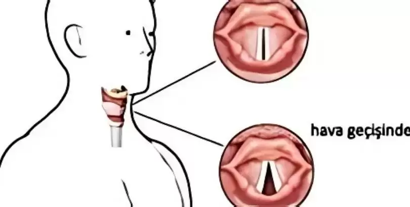ses-teli-nodulu-ve-polipler