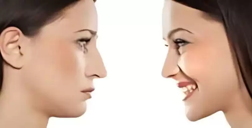 tekrar-nazal-rekonstruktif-cerrahi-veya-revizyon-rinoplasti