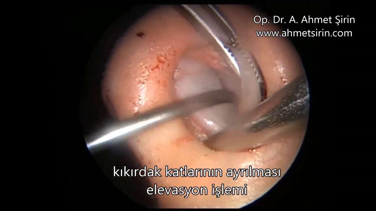 Nasal Septum Deviation (Disease Or Medical Condition),Septoplasty (Medical Treatment),septum deviasyonu ameliyatı,deviasyon ameliyatı,burun kıkırdak amaliyatı,burun,septum,deviasyon,konka,endoscopic septoplasty,inferior konka,konka hipertrofi,nasal s
