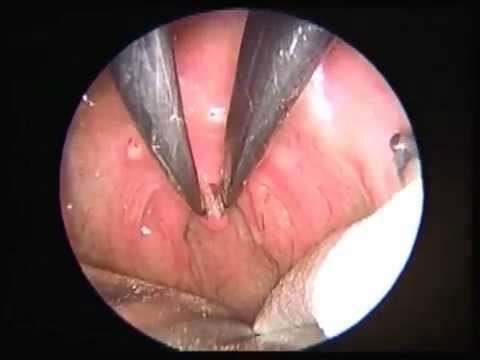 horlama,radyofrekans uvuluparingoplasty,OSAS,obstructive sleep apnea syndrome treatment,horlama ameliyatı,Apnea (Symptom),apne tedavisi,Obstructive sleep apnea,tıkayıcı uyku hastalığı,uykuda nefes durması,uykuda tıkanma,Sleep Apnea (Symptom),Op.D