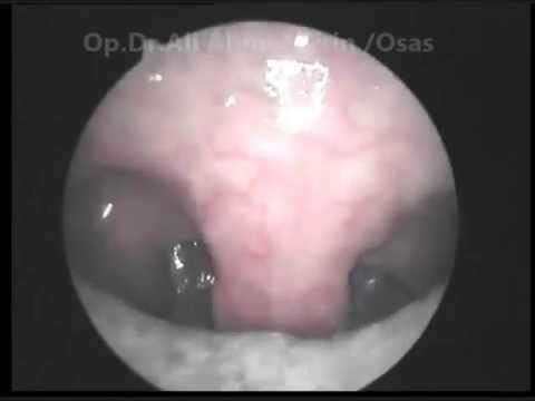 horlama,apne,uyku apnesi,horlama cerrahisi,uykuda tıkanma,uykuda nefessiz kalma,horlama ameliyatı,apne ameliyatı,uyku apnesi nedir,radyofrekans tedavisi,horlama çözümü,horlama tedavisi,apne tedavisi,Sleep Apnea (Symptom),Otolaryngology (Medical Spe