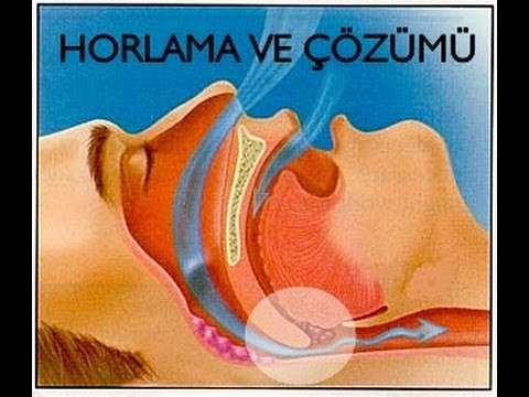 uyku apnesi,uykuda tıkanma,apne,uykuda nefes durması,uykuda nefesin kesilmesi,uyku bozuklukları,horlama tedavisi,horlamanın çözümü,horlamadan nasıl kurtulunur,horlama cerrahisi,horlama ameliyatı,horlama,Snoring (Symptom),tıkanma