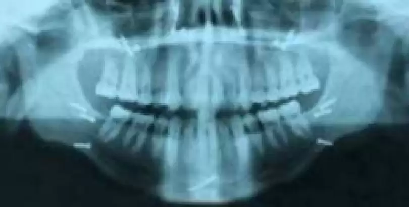 yuz-kiriklari-ve-ameliyatlari