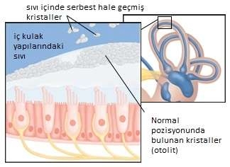 vertigonun-nedenleri