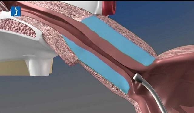 yeni-balon-kateter-yontemi-nasil-yapilir