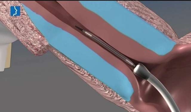 yeni-balon-kateter-yontemi-nasil